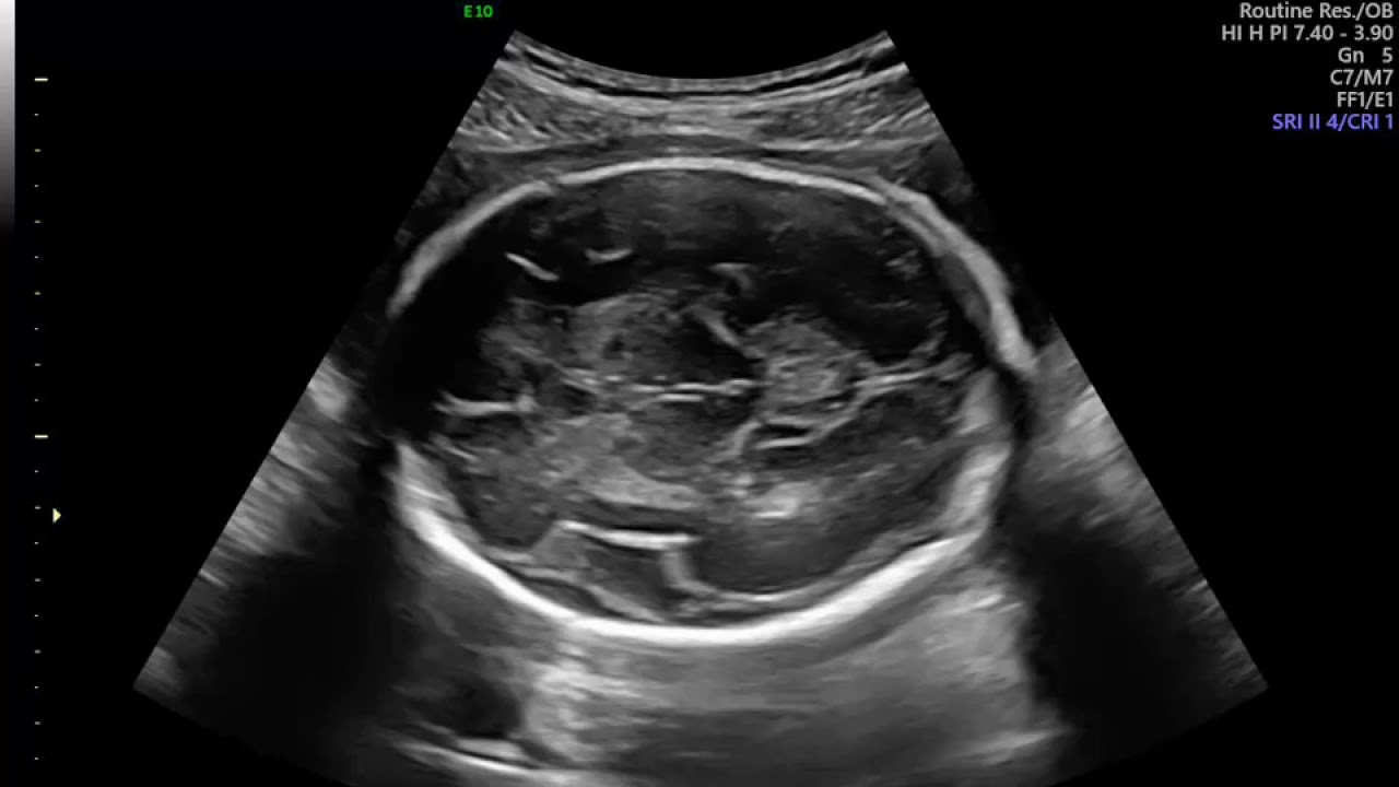 ULTRANEUROSONOGRAFIA