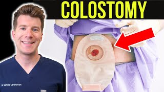 Doctor explains Colostomy (Stoma)