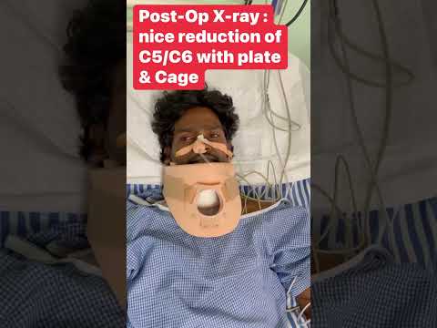 Successful Cervical facet dislocation and Spinal Cord Injury surgery| Dr.Sudheer Kumar pothu