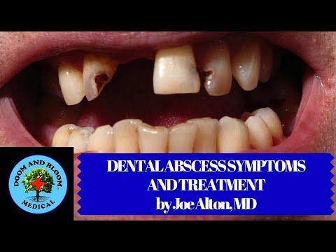 Dental Abscess Symptoms and Treatment in Survival