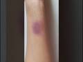 How to create fake bruises/ fake injury 🤕#trending #sfx #sfxmakeup #bruises #fakecut #fakeinjury