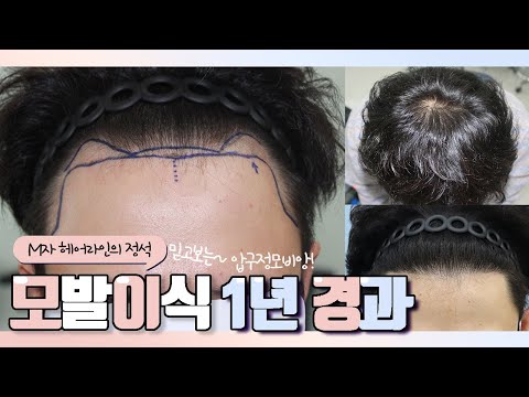 30대 초반 남성,절개,2500모, M자 모발이식 1년 경과영상!