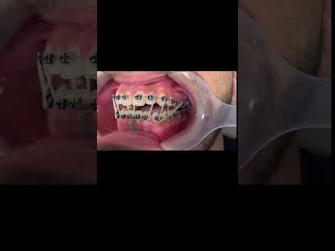 Open bite orthodontic treatment  , Before & After Case