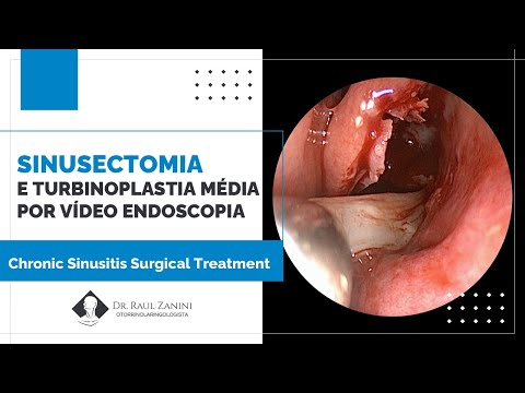 Miniatura: Turbinoplastia Média e Sinusectomia Maxilar