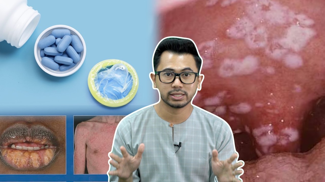 Cara Cegah HIV Sebelum dan Selepas Terkena