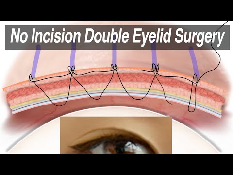 Non-Incisional Asian Double Eyelid Surgery (Suture Technique for Monolid Correction) Animation