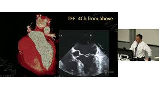 Imaging Assessment of the Left Ventricle – Prof Greg Scalia