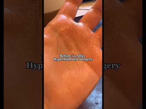 Before v After Hyperhidrosis Surgery for excessively sweaty hands #excessivesweating #hyperhidrosis