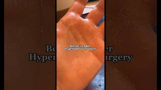 Before v After Hyperhidrosis Surgery for excessively sweaty hands #excessivesweating #hyperhidrosis