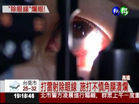 打雷射除眼線 角膜潰爛險失明