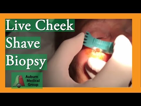 La crema per il viso da pigmentary nota su un corpo Strumenti professionali per eliminazione di posti di pigmentary