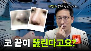 🚨코 끝이 뚫린다고요?🚨 코 수술 한 사람 필수 시청!