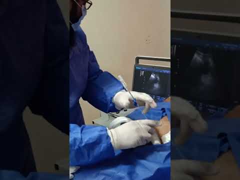 Ultrasound guided aspiration of abdominal cystic lesion. Dr. El Sayed Imam NHTMRI Cairo Egypt.