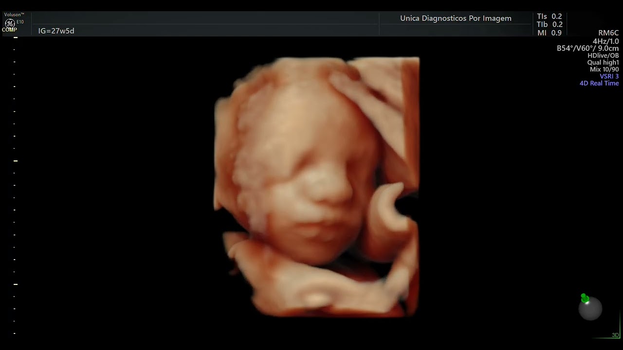 Ultrassom 4D HD Live - (27 semanas de gestação)