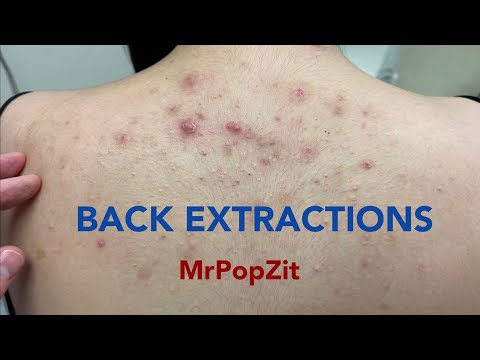 Tons of blackheads on the back. Acne extractions. Blackheads and whiteheads. Mining pore dirt.