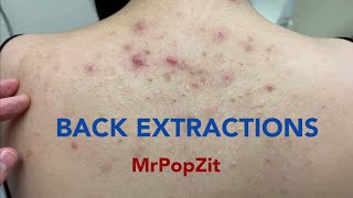 Tons of blackheads on the back. Acne extractions. Blackheads and whiteheads. Mining pore dirt.