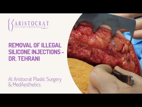 Removal of Illegal Silicone Injections- Dr. Tehrani