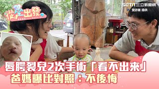 生下唇腭裂兒  2次手術「看不出來」！爸媽曝比對照：不後悔