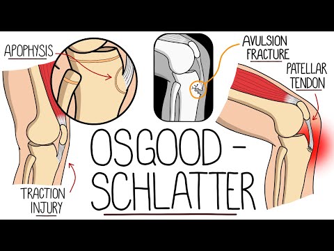 Morbus Osgood-Schlatter leicht gemacht (Apophysitis des Tuberculum tibialis)