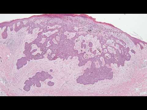 C44.9_Basal cell carcinoma with amyloid deposition_skin_excision