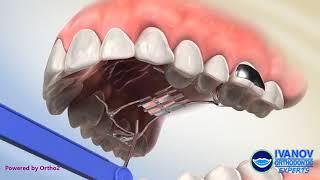Palatal Expander Appliance and How It Helps
