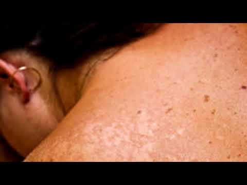 Il pigmentary nota su pelle e cancro I mezzi per candeggiare di lentiggini