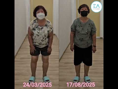 Knee PRP - Before & After