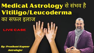 Medical Astrology से संभव है Vitiligo/Leucoderma का सफल इलाज | Prashant Kapoor