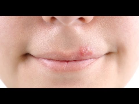 Pormalin-ginagamot fungus Cream ng halamang-singaw sa paa presyo