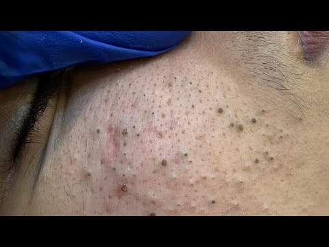 Deep Cleansing Routine | Acne Treatment & Blackhead Removal