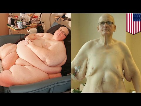 Kości na nogi obraz kciuk Wspólne odkształcenie drugiego palca