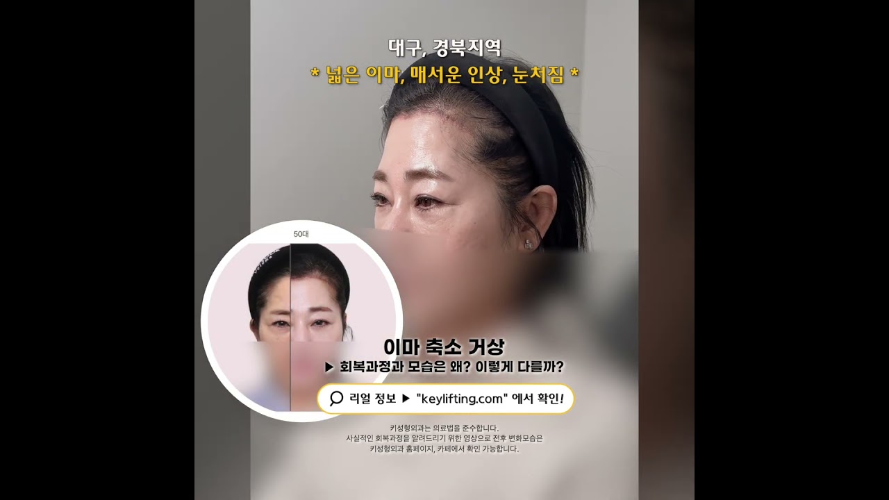 50대 이마축소 거상