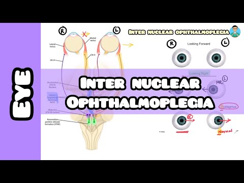 Inter nuclear ophthalmoplegia (INO) made simple