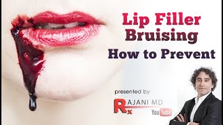 Lip Filler Bruising-How to Prevent it