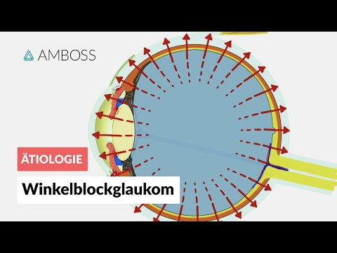 Acute angle-closure glaucoma with pupillary block - AMBOSS Video
