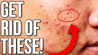 Get Rid of Red Spots & Dark Spots (FROM EXPERIENCE)
