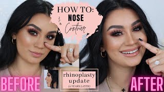 Nose Contour + Rhinoplasty Update!