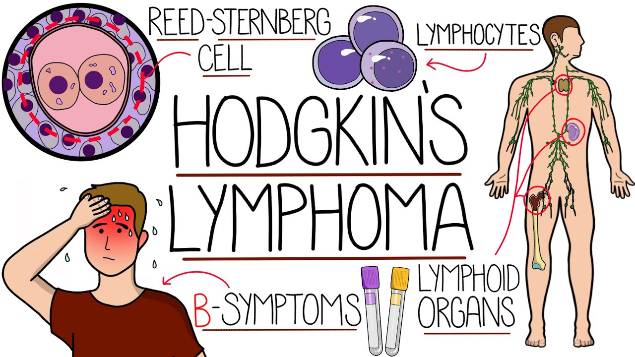 Hodgkin's Lymphoma Explained (With Classification)