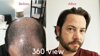 Full 360 View Of My Hair And A Great Hair Day With A Hair Replacement or Hair System