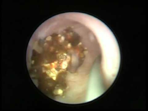 Ingrossamento dei linfonodi sul lato sinistro sul trattamento del collo E meglio quando il dolore lombare diclofenac o Movalis