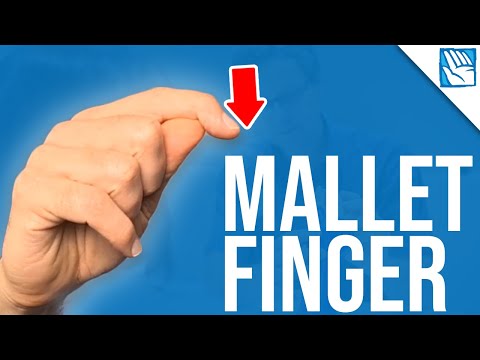 Can't Lift Your Fingertip ? - Mallet Finger  - Part 1