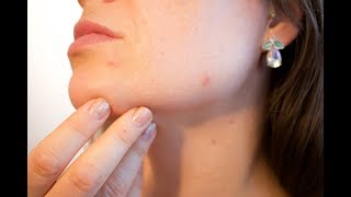 How To Quickly + Effectively Use Honey For Blackheads Removal