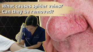 What Causes Spider Veins? Can They Be Removed?