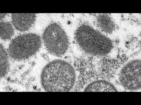NJ Monkeypox Virus Latest