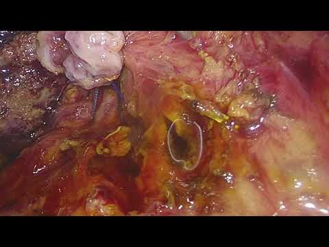 『微創手術』腹腔鏡總膽管取石及Ｔ型管放置laparoscopic choledocholithotomy with T tube drainage
