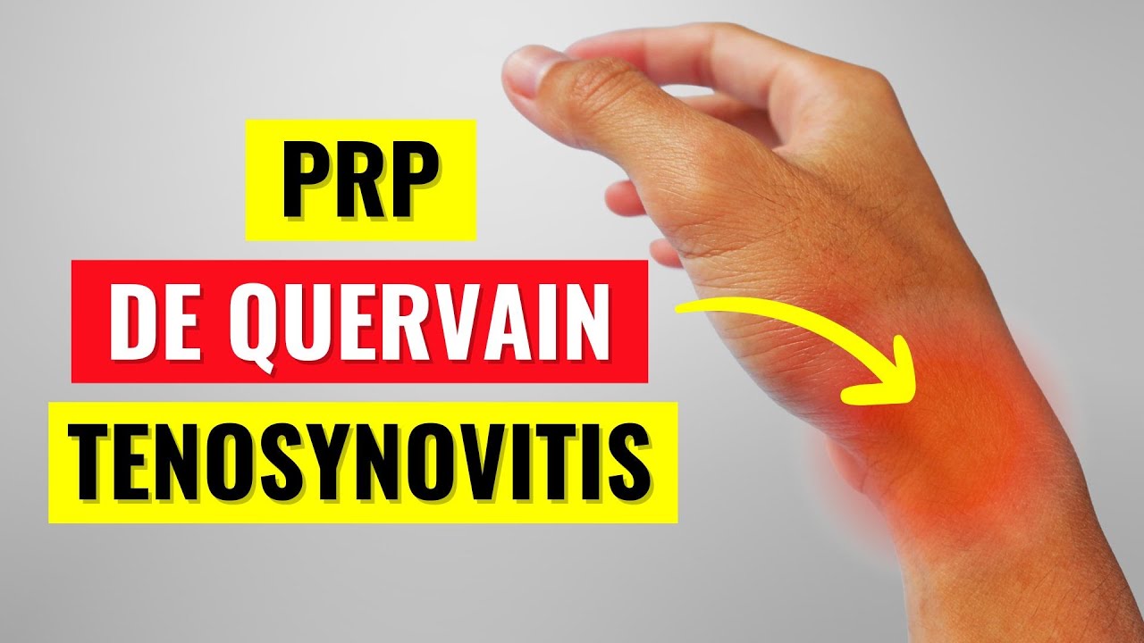 PRP Injections for De Quervain's Tenosynovitis: What the Research Shows
