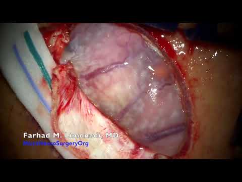 Brain surgery: Removal of Glioblastoma Multiforme from Motor Cortex