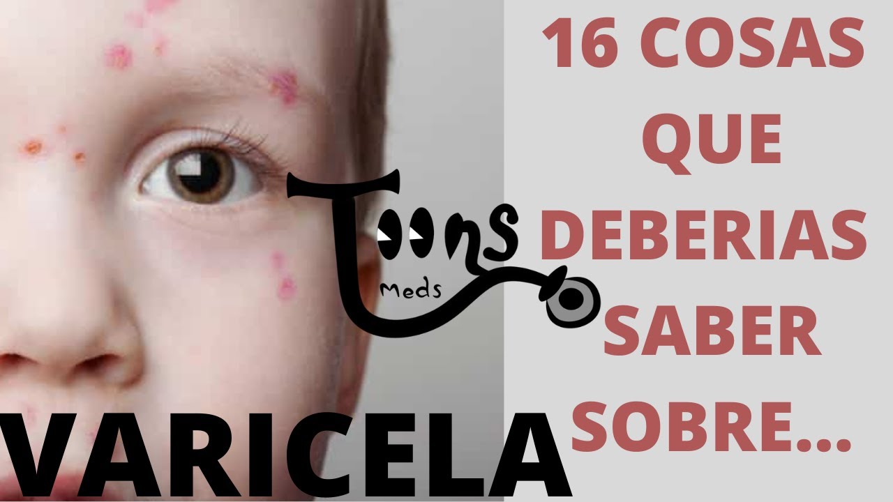 VARICELA:16 COSAS QUE DEBERÍAS (VARICELA EN NIÑOS, SIGNOS SINTOMAS, TRATAMIENTO PREVENCIÓN,ENARM)