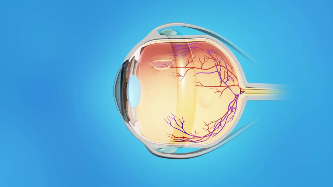 Detached Retina: Scleral Buckle