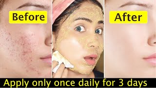 Teenager Skin Transformation Challenge-Pimples, whiteheads, acne marks clearing & face brightening
